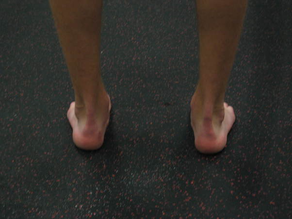 Endeavor Sports Performance-Over Pronation